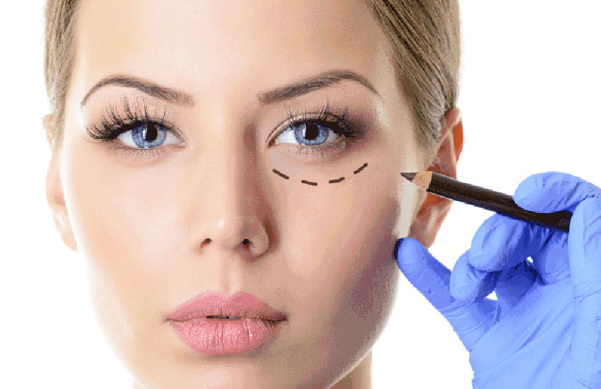 Blepharoplasty