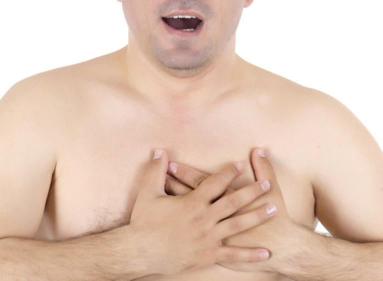 Gynecomastia