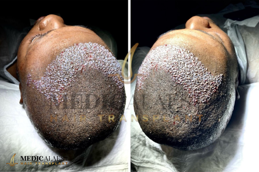 Medicalaest - AFRICAN HAIR TRANSPLANT