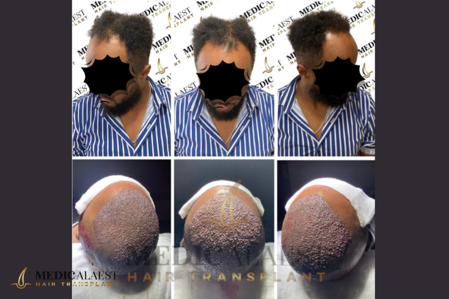 Medicalaest - AFRICAN HAIR TRANSPLANT