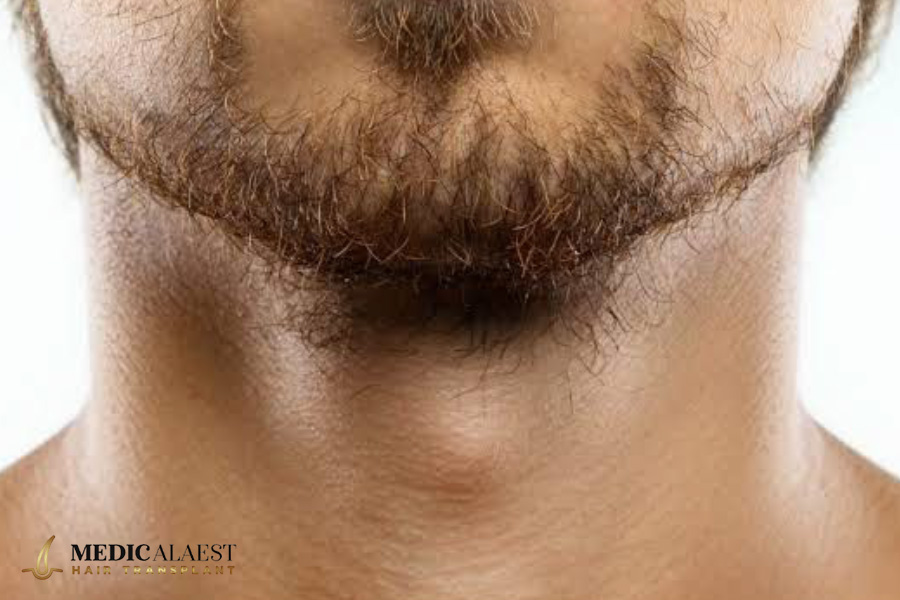 Medicalaest - BEARD HAIR TRANSPLANT