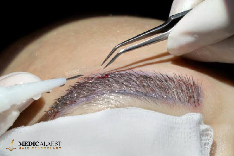 Medicalaest - EYEBROW HAIR TRANSPLANT