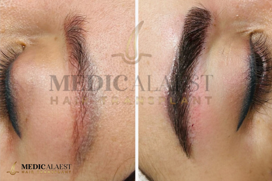 Medicalaest - EYEBROW HAIR TRANSPLANT