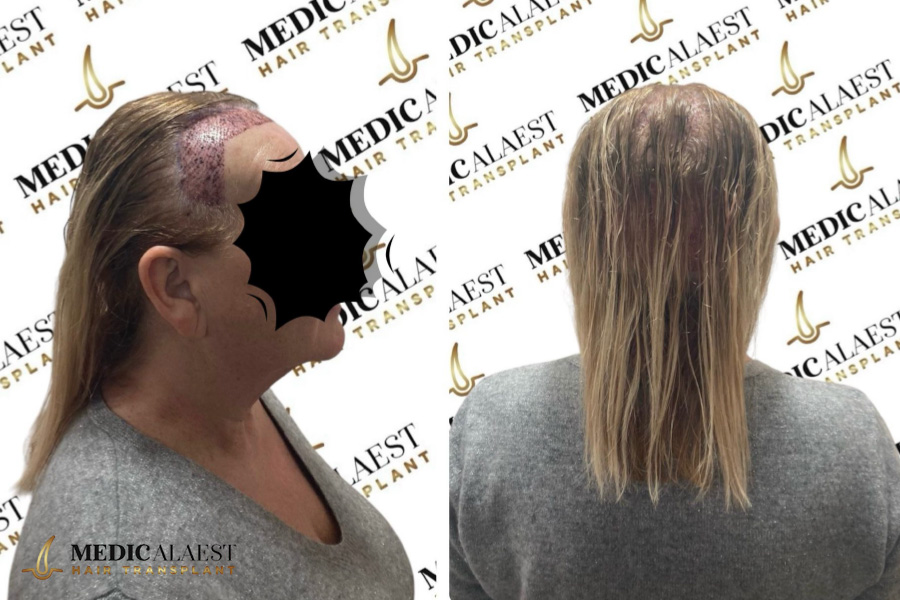 Medicalaest - FEMALE HAIR TRANSPLANT