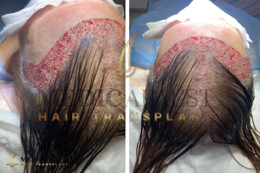 Medicalaest - FEMALE HAIR TRANSPLANT