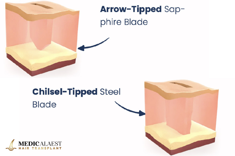 Medicalaest - FUE SAPHIR HAIR TRANSPLANT