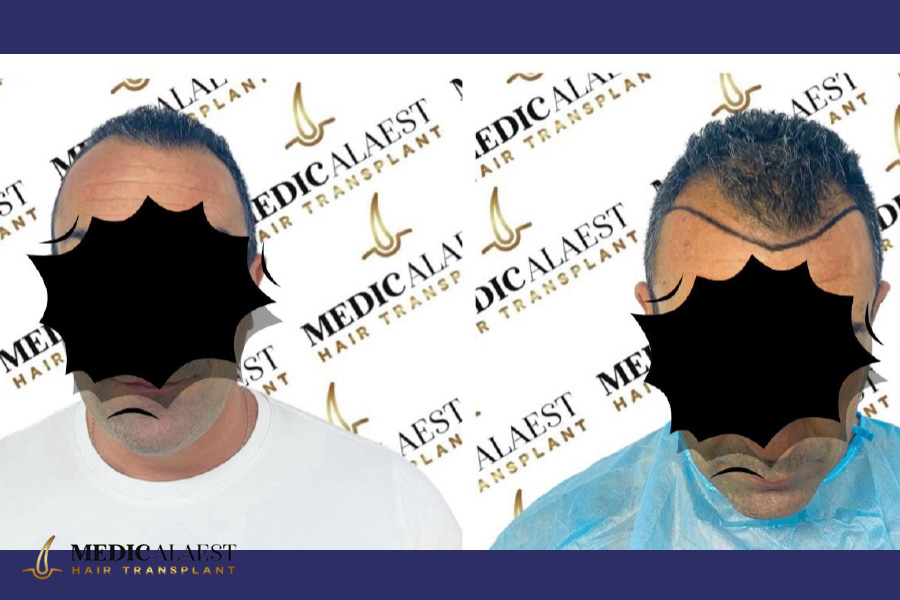 Medicalaest - HAIR LINE RESTORATION