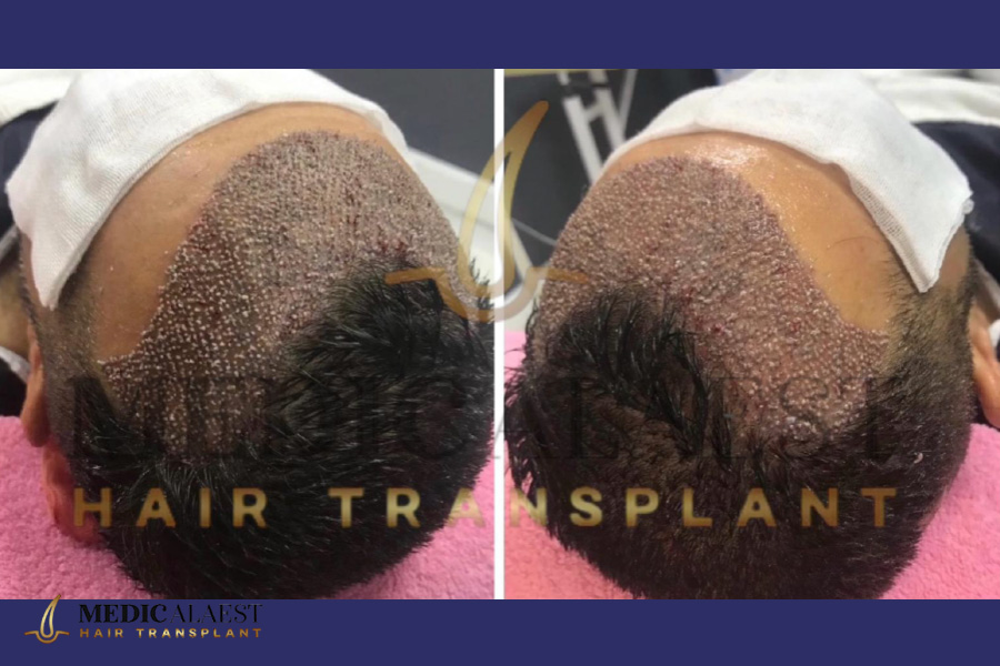 Medicalaest - NO-SHAVING HAIR TRANSPLANT