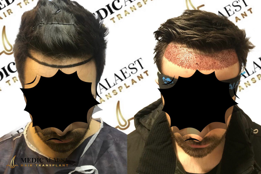 Medicalaest - NO-SHAVING HAIR TRANSPLANT
